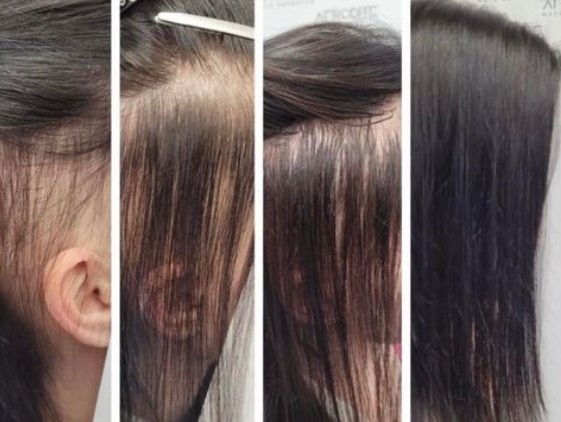 combline extensions for hair loss in saffron walden combline extensions for hair loss in saffron walden